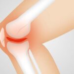 관절염