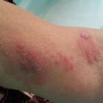 대상포진