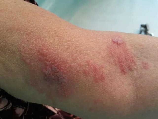 대상포진