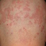 지루성-피부염