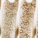 골다공증