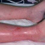 봉와직염