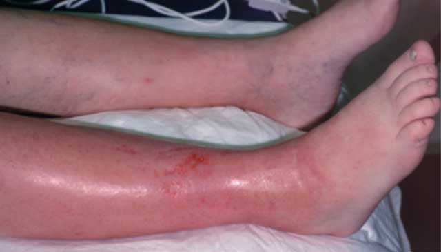 봉와직염